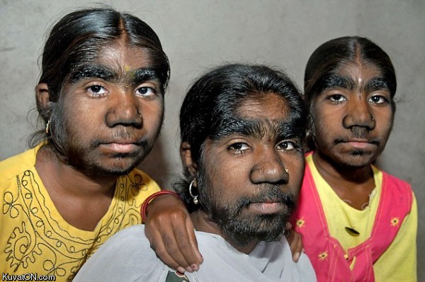 hypertrichosis_universaliswerewolf_sisters.jpg